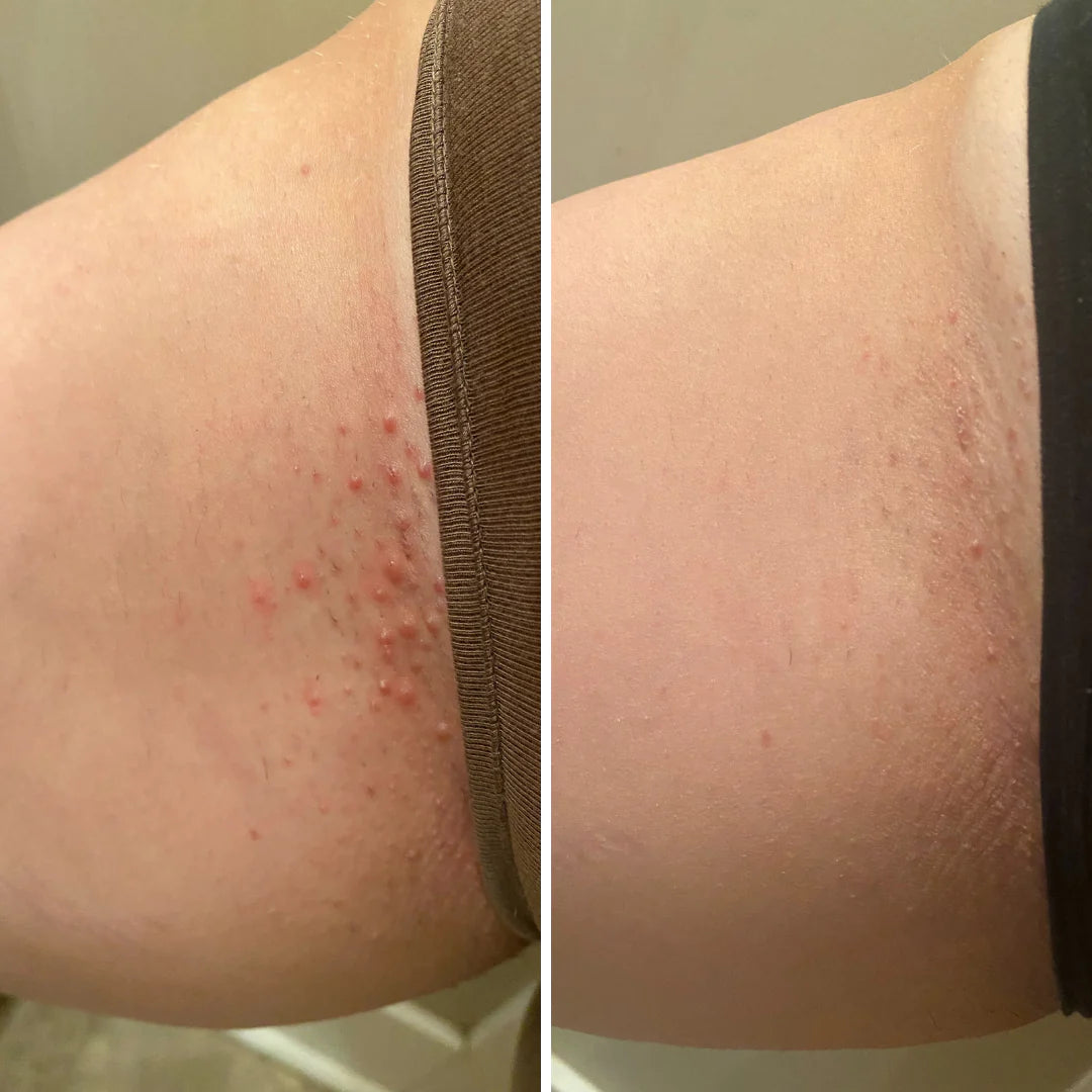 Eronon Smoothing Solution Ingrown Hair Treatment