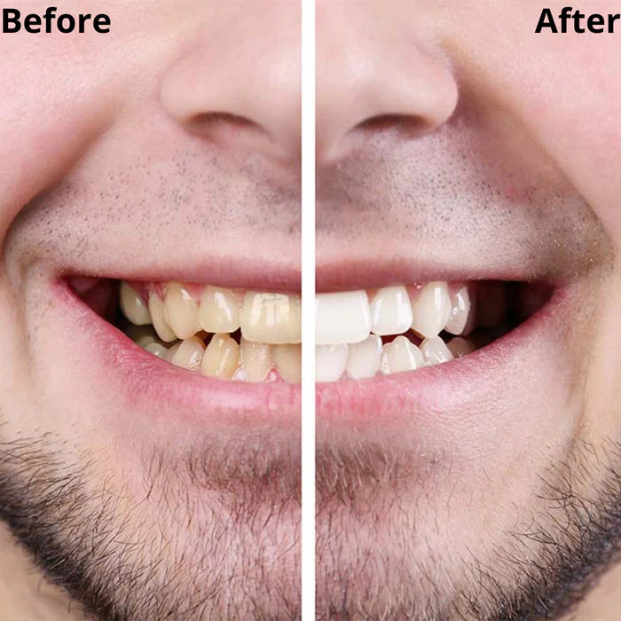 Teeth whitening pen