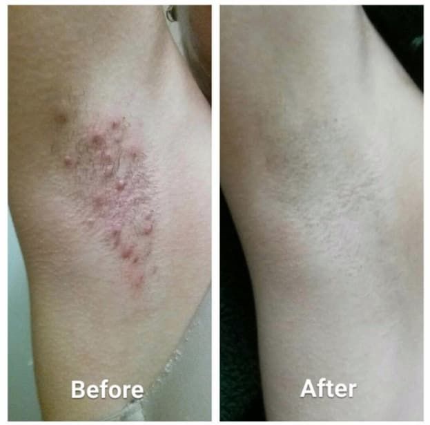 Eronon Smoothing Solution Ingrown Hair Treatment